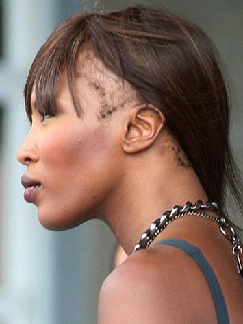 What you need to know about traction alopecia