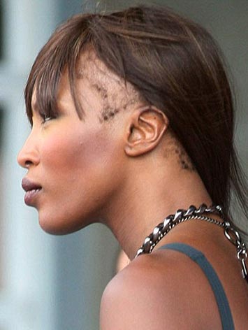 what is traction alopecia