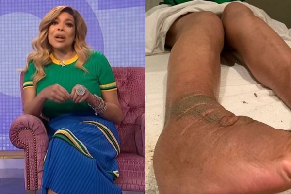 Wendy Williams lymphedema