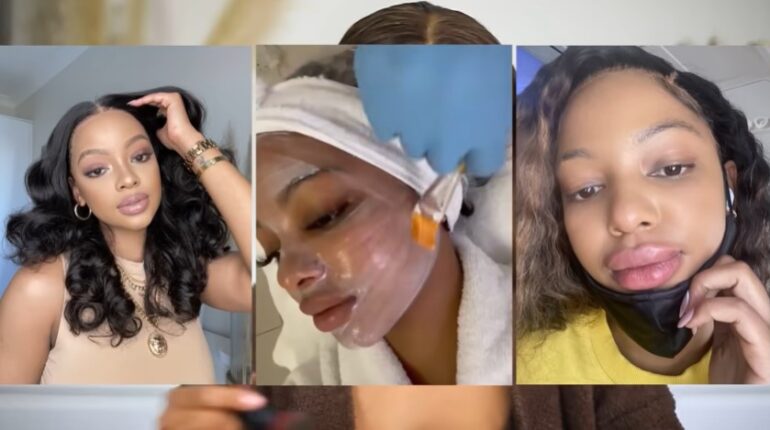 Mihlali Ndamase shares pictures of her lip filler procedure 