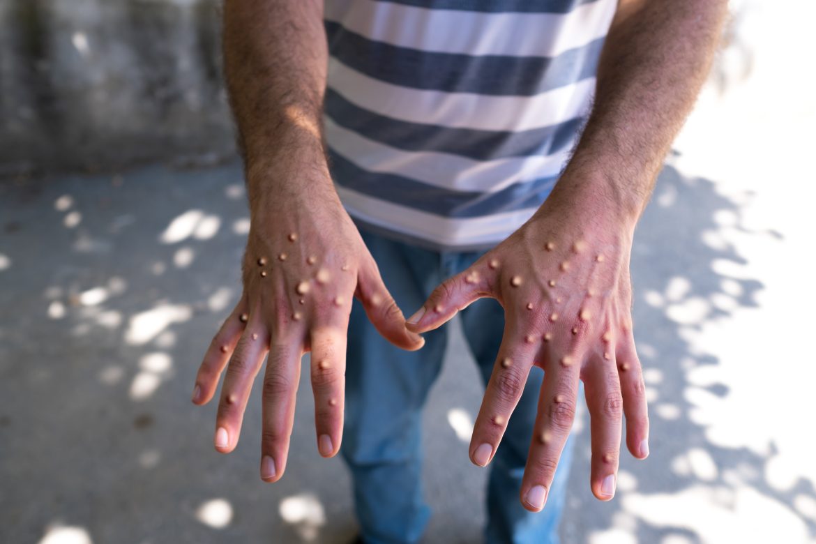 Man shows mpox infection on hands