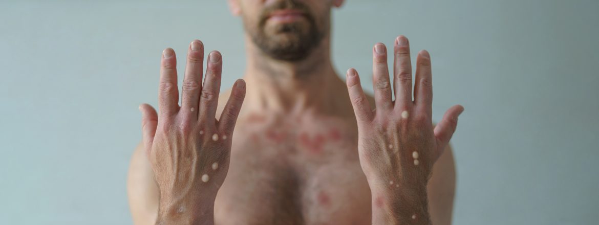 died from Monkeypox