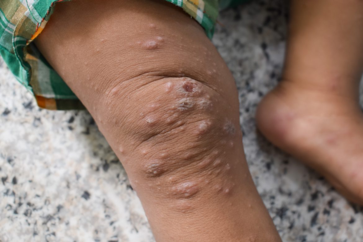 negative for mpox