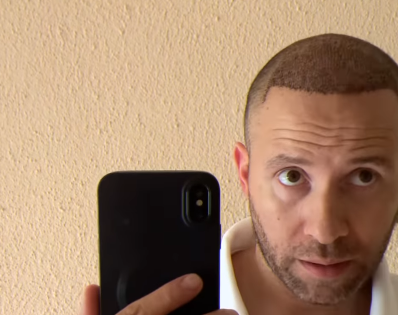 Clint Brink opens up about his hair transplant journey