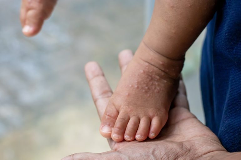 hand with hand-foot-mouth disease infected child's feet on an adult hand or HFMD originating from enterovirus or coxsackie virus, care for hand foot mouth disease