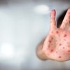 Gauteng battles rising measles cases