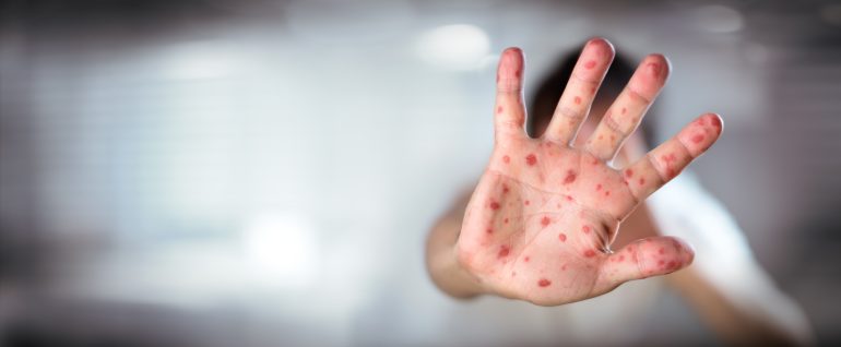 Gauteng battles rising measles cases