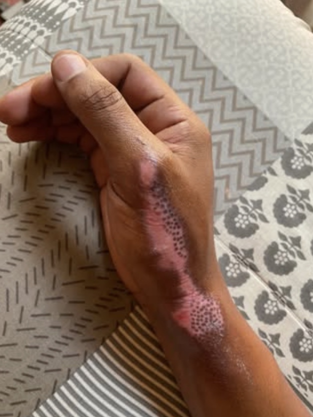 The River star Ontshiametse Molekoa suffers burn injuries in cooking accident