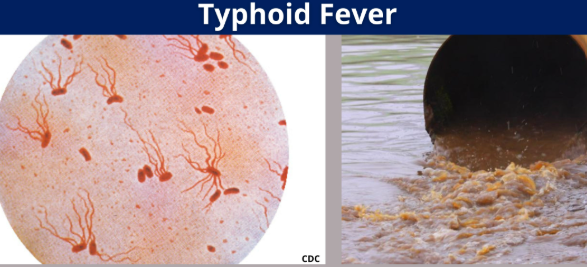 Typhoid fever