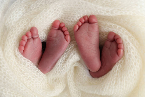 One conjoined twin from Limpopo hospital dies following multiple organ failure 