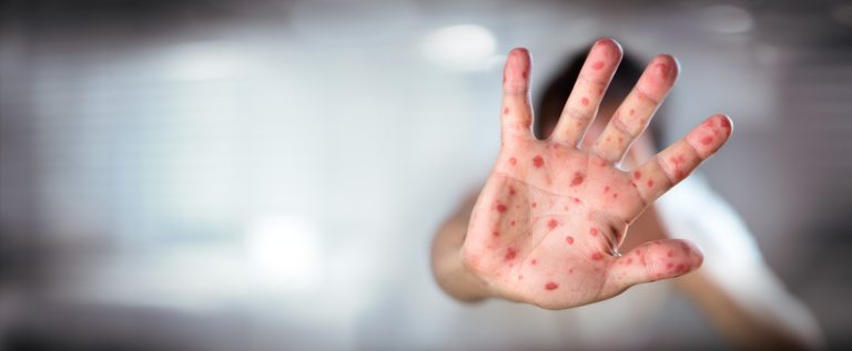 SA declares public health emergency as measles cases surge past 3,400